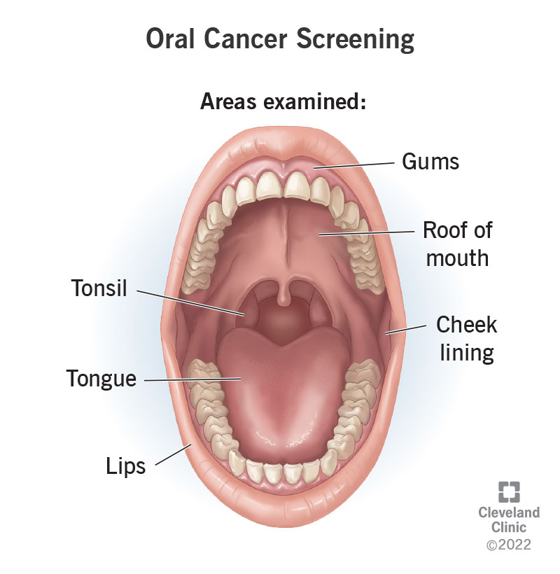 The areas of your mouth examined during an oral cancer screening.