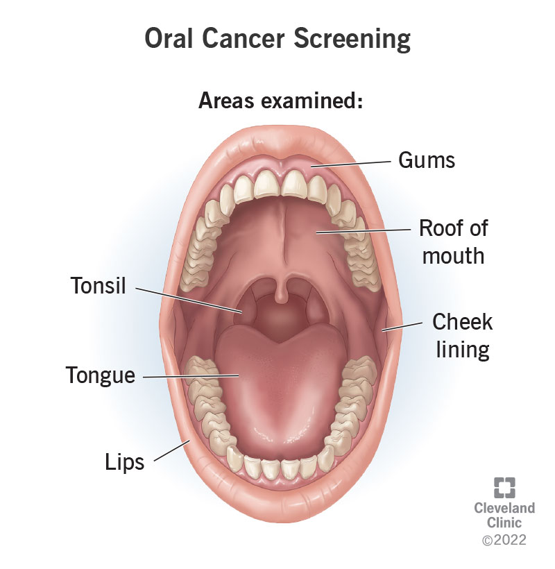 oral cancer under tongue