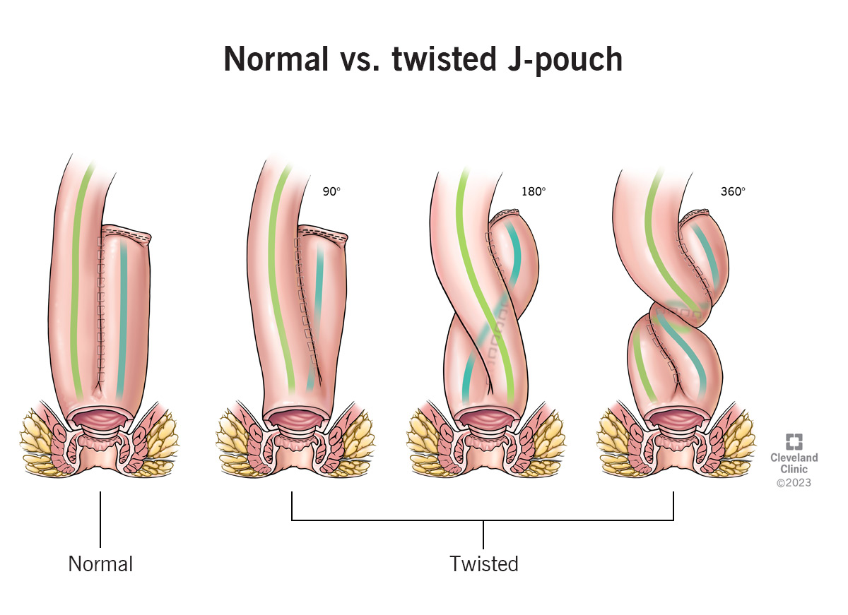 A twisted J-pouch may be rotated 90 degrees, 180 degrees or 360 degrees, obstructing the opening.