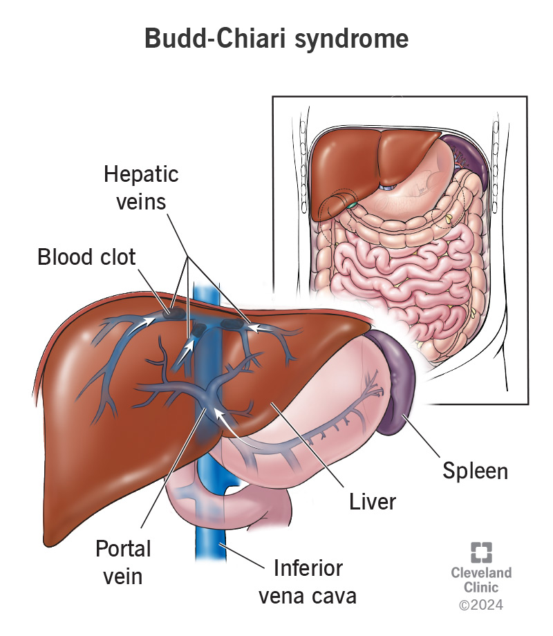 Budd-Chiari syndrome blood clots causing obstructions in hepatic veins
