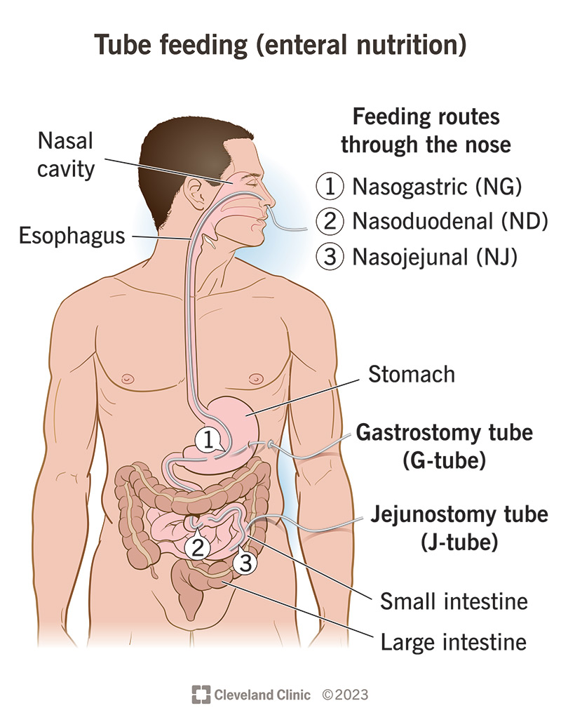 Feeding tube placement within the digestive system