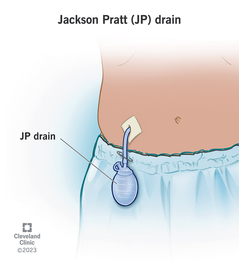 A Jackson-Pratt drain positioned to collect fluid from a stomach wound