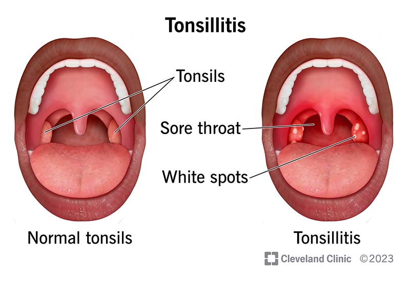Healthy tonsils versus red and swollen tonsils in tonsillitis. White spots may be present.