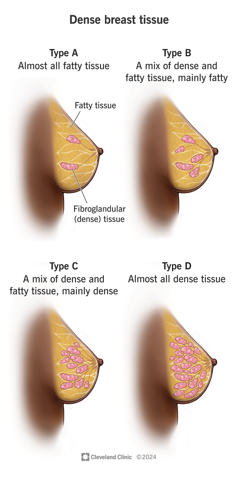 It’s normal to have some dense breast tissue (A). Having a lot of dense tissue (D) may increase your risk of breast cancer