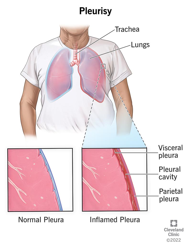 Illustration of normal pleura around the lungs compared to inflamed pleura of pleurisy.