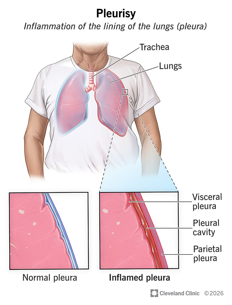 Anatomy of lungs inside chest, with normal pleura and inflamed pleura (pleurisy)