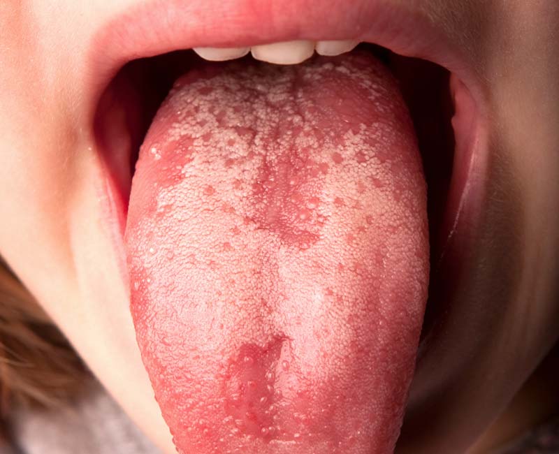 Geographic tongue is named for the condition’s most noticeable symptom: A pattern of red and white patches (lower right section of tongue) that resemble the way land masses and oceans are shown on maps.