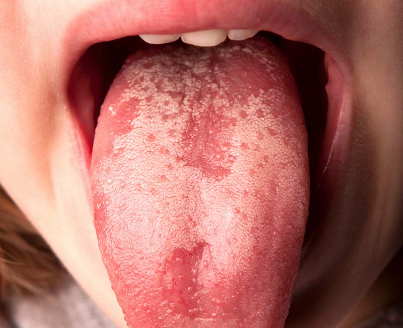 A geographic tongue with a pattern of red and white patches (lower right part of tongue) resembling land and oceans on a map.