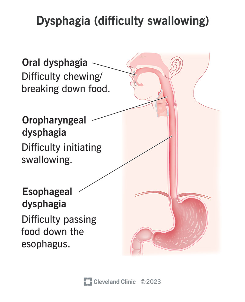 The locations associated with oral, oropharyngeal and esophageal dysphagia.