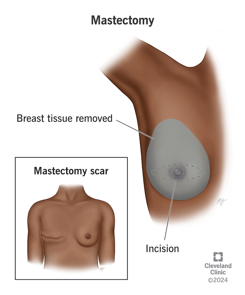 This surgery removes breast tissue, your nipple and underarm lymph nodes. The incision (cut) leaves a scar (inset).