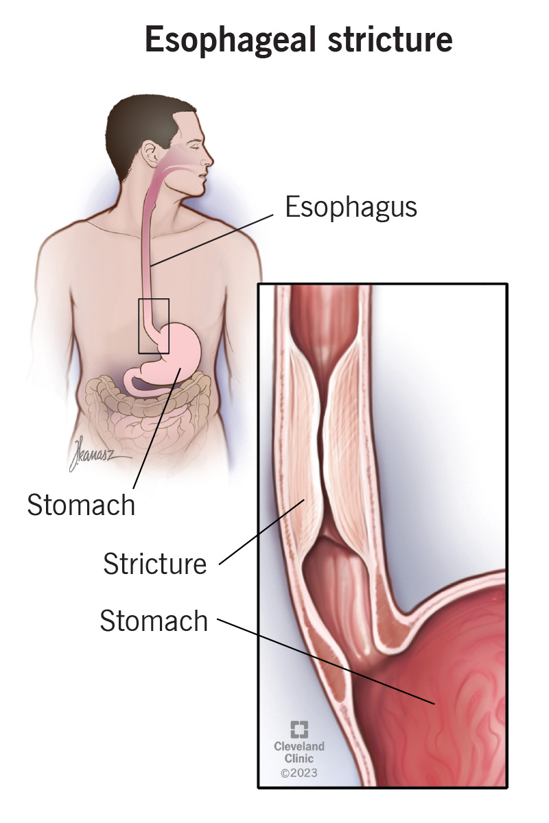 Esophageal stricture is when your esophagus (food pipe) narrows.