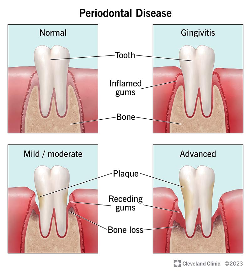 Stages of periodontal disease: gingivitis, mild/moderate periodontitis, advanced periodontitis.