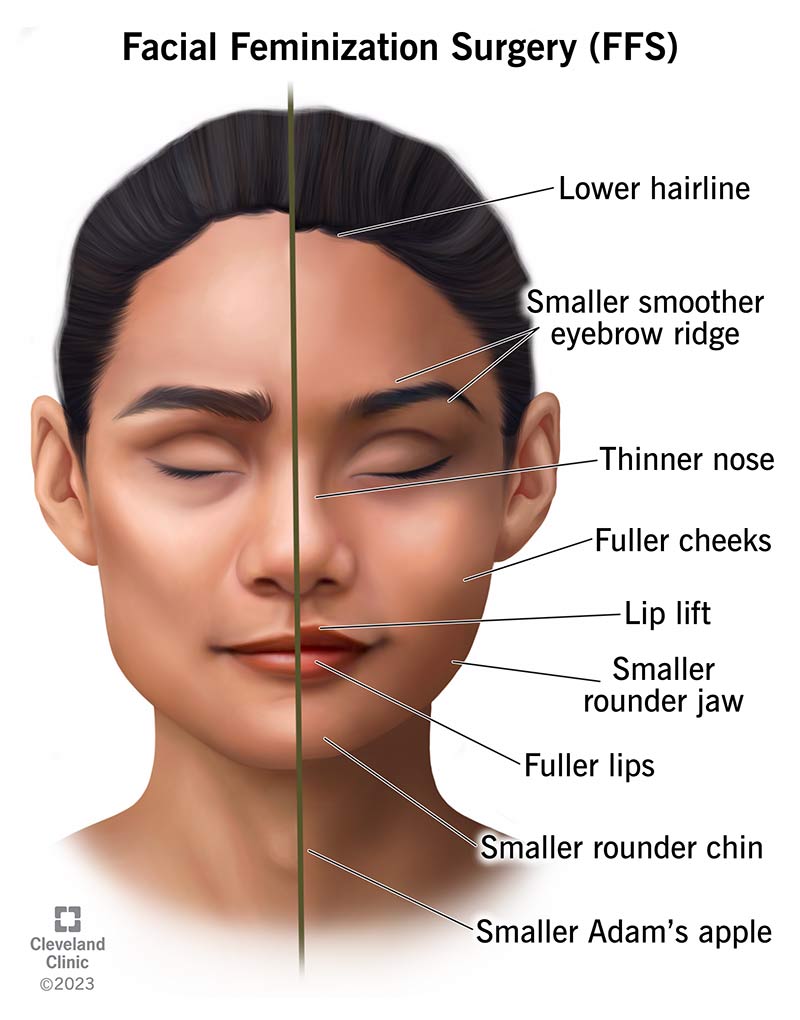 Split view of facial features, facial feminization surgery before and after.