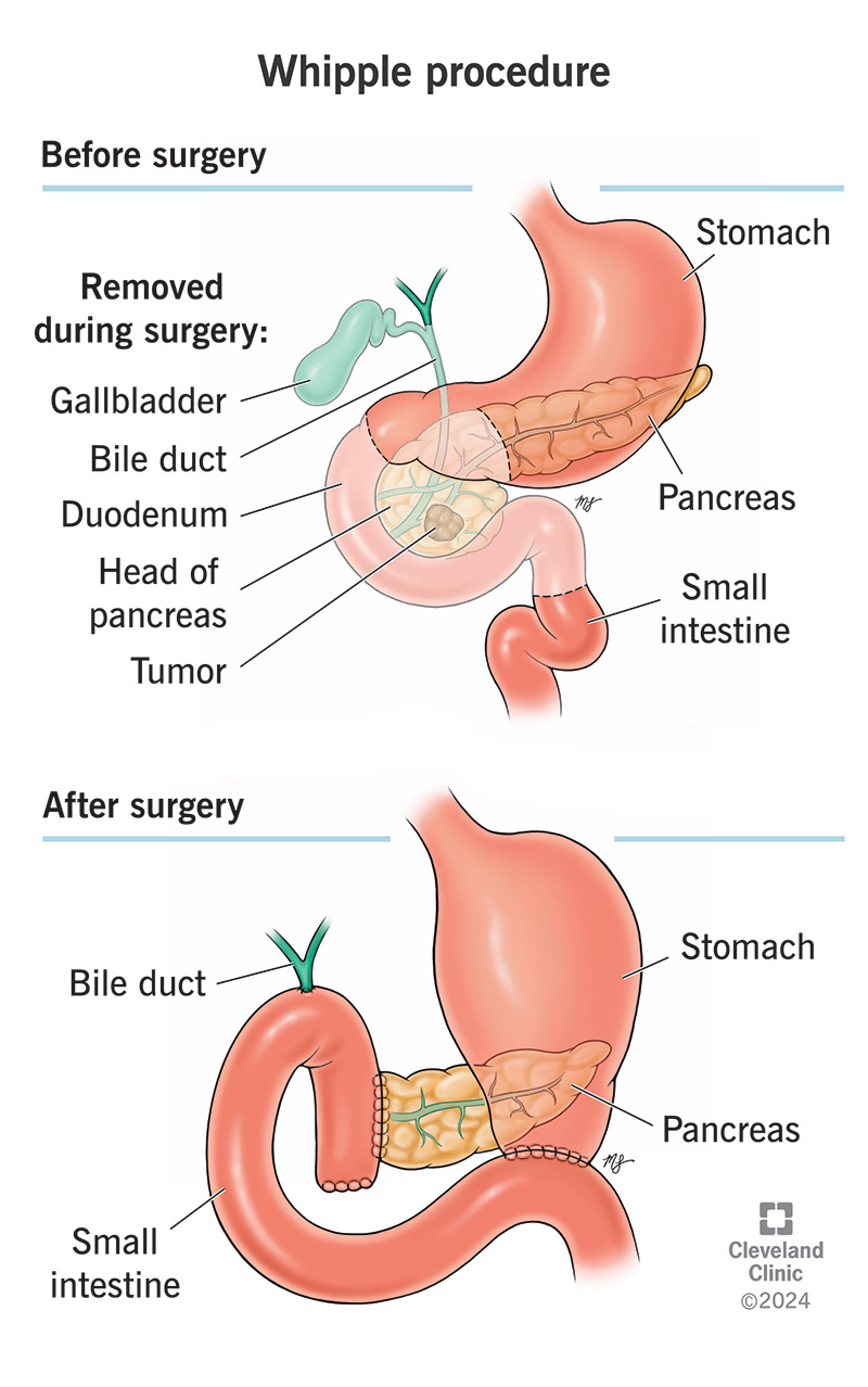 What a pancreas looks like before and after the Whipple procedure.