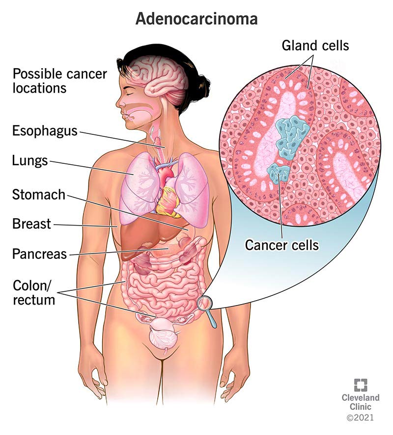 human body showing Adenocarcinoma Cancer