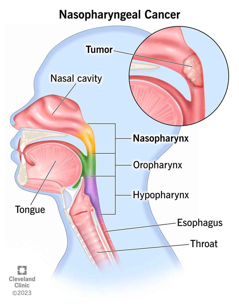 Nasopharyngeal cancer in the nasopharynx, located just below the nasal cavity and above the oropharynx.