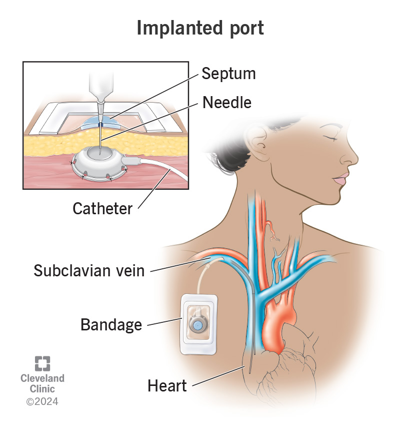 An implanted port and catheter in a person’s chest, threaded into their subclavian vein