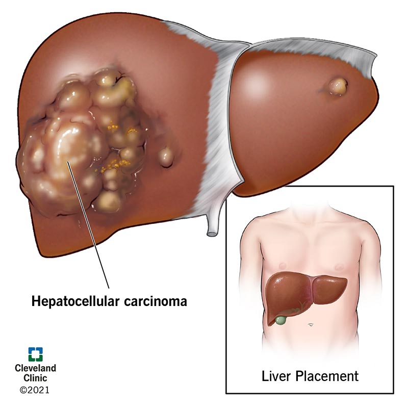 Hepatocellular carcinoma on a liver