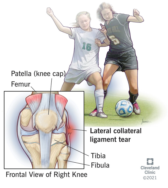 Lateral collateral ligament (LCL) tear