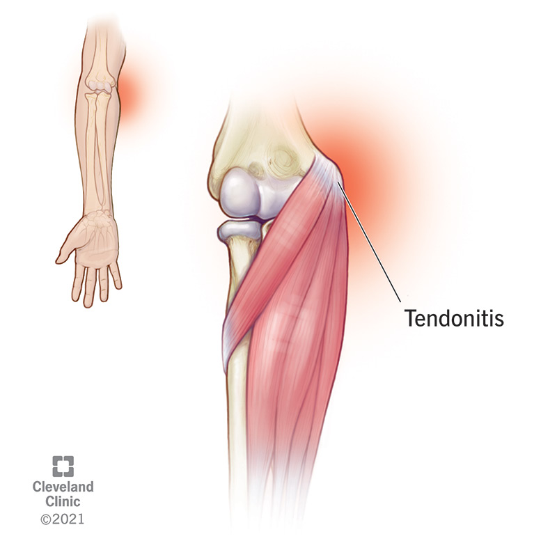 Golfer's elbow (medial epicondylitis)