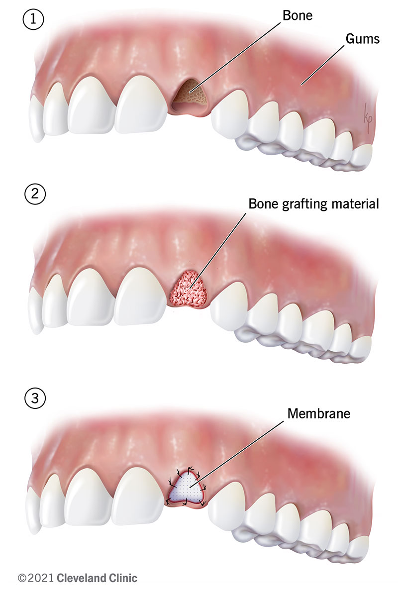 healing socket after tooth extraction