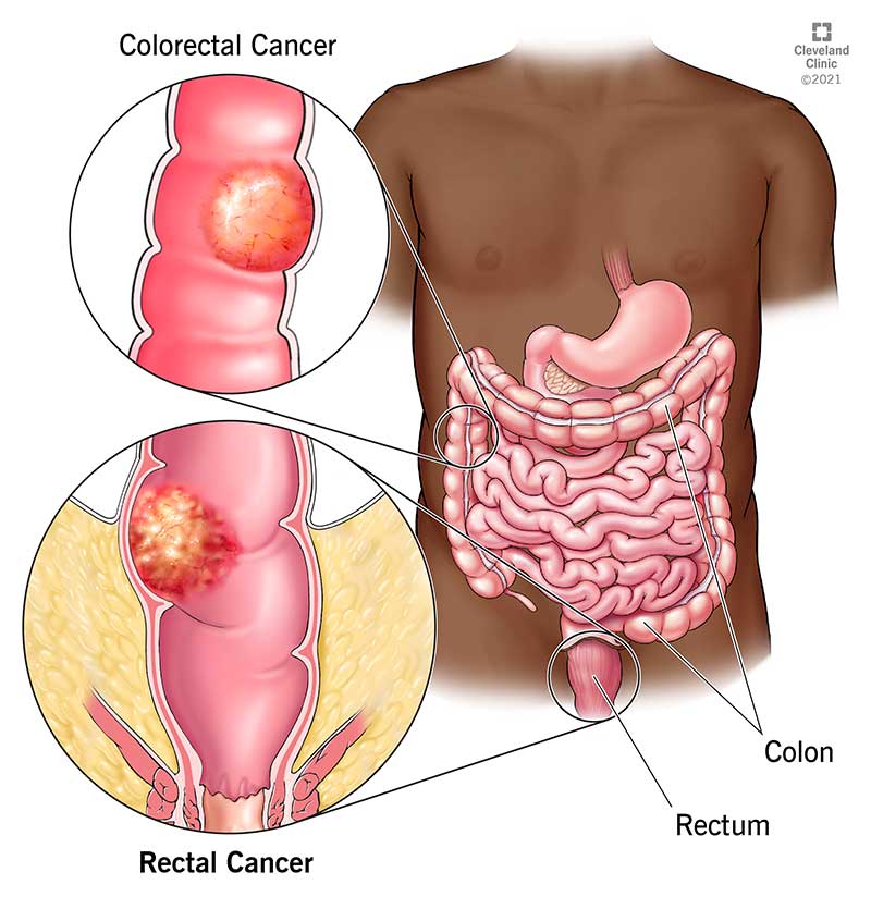 rectal cancer and colon cancer)