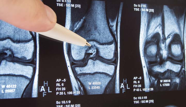 osteoarthritis knee mri