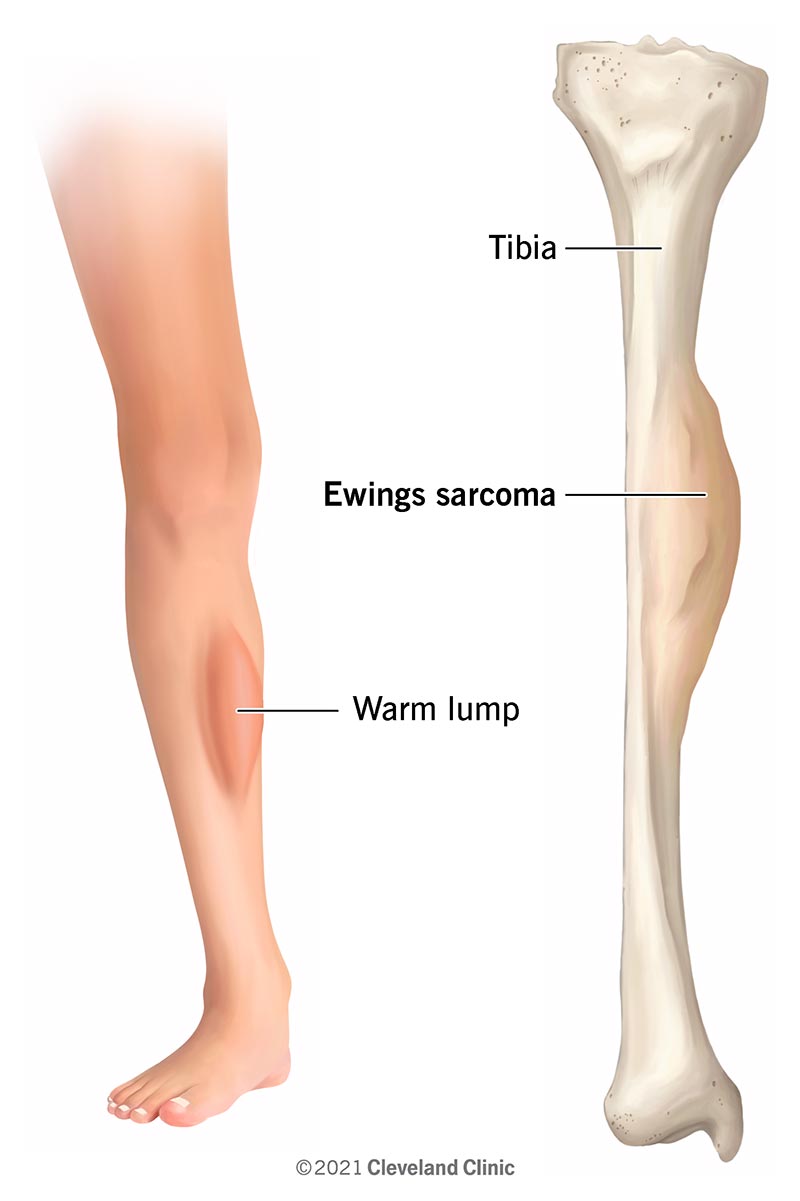 Soft Tissue Sarcoma: Symptoms, Treatment & Prognosis