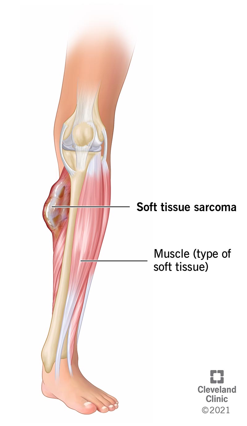 person with soft tissue sarcoma cancer