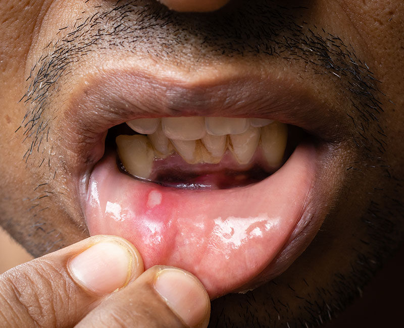 Person pulling down lower lip to show mouth ulcer.