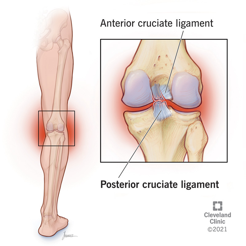 PCL tear in the knee