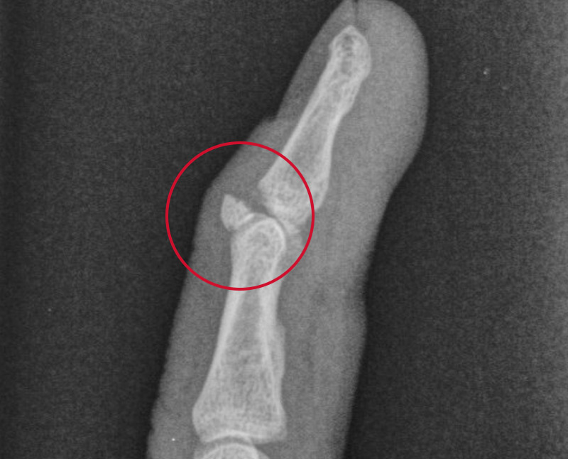 Avulsion Fracture: What It Is, Causes, Symptoms, Treatment & Recovery