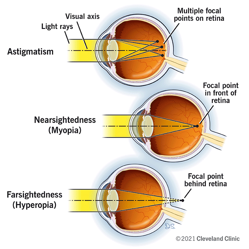 The visual axis and light rays create different focal points on, behind and in front of the retina of the eye in astigmatism, nearsightedness and farsightedness.
