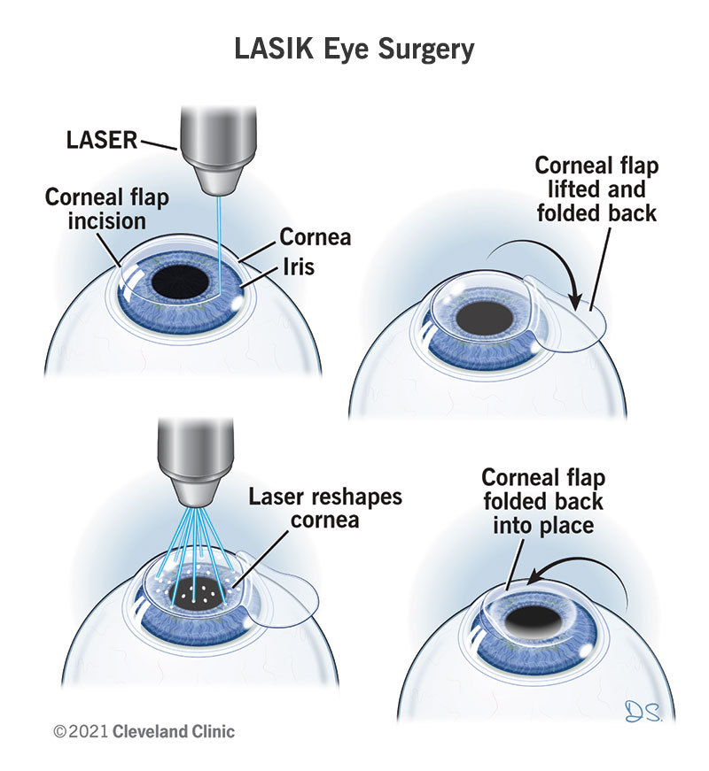Illustration showing the steps in a LASIK eye surgery.