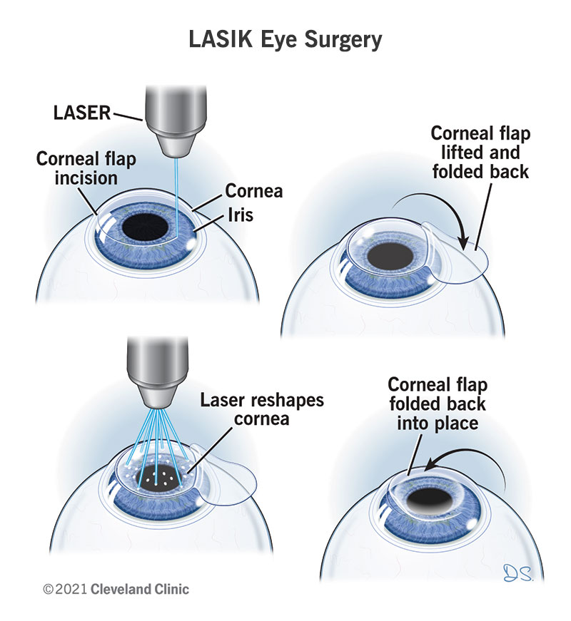 Understanding The Basics Of Lasik Surgery