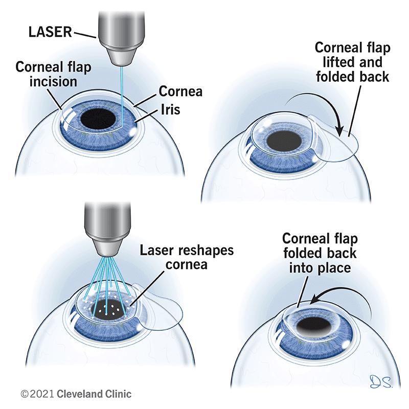 does insurance cover lasik eye surgery cost