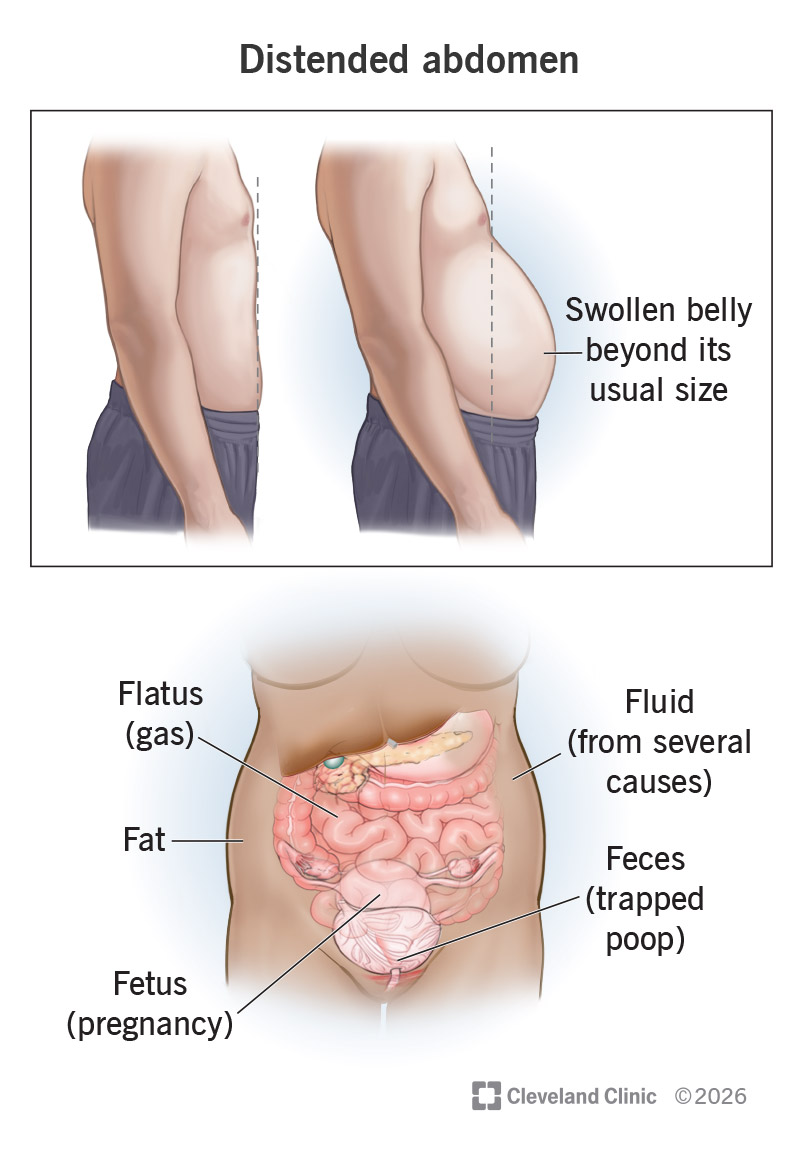 Five substances inside the belly that can cause distended abdomen, including gas, pregnancy, trapped pooped, fluid and fat