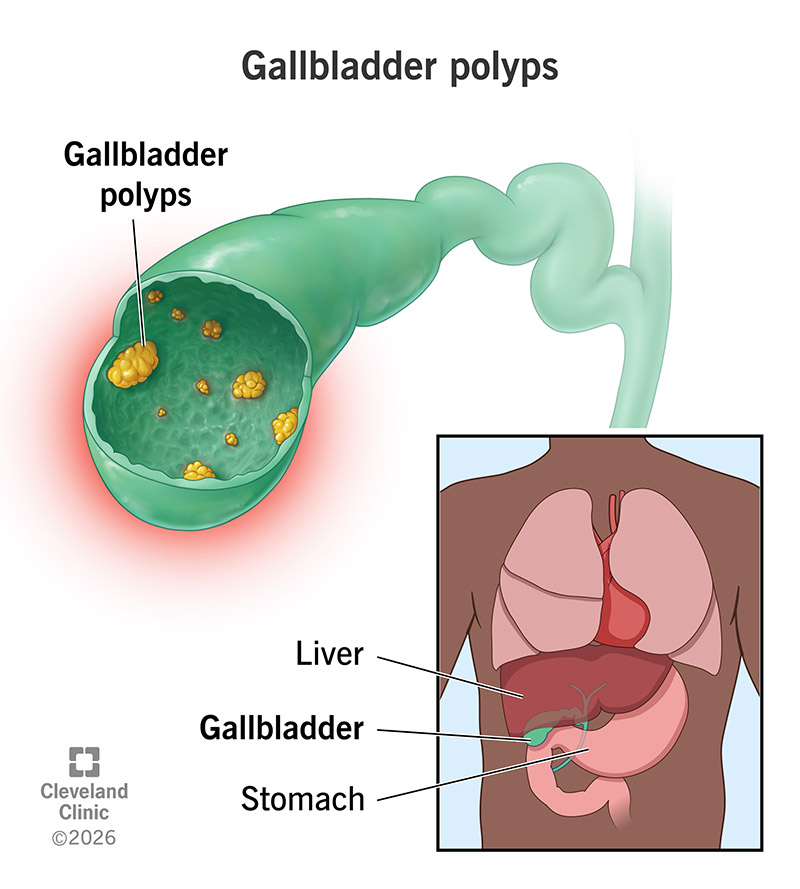 Polyps on the inside of the gallbladder