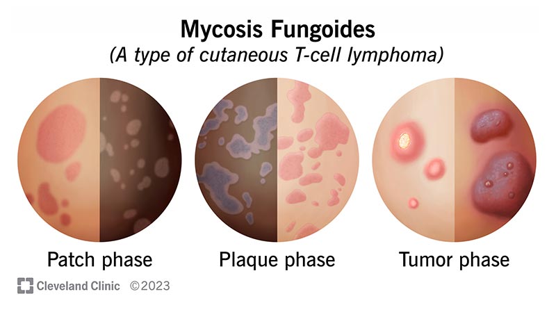 Illustrations showing the patch, plaque and tumor phases of mycosis fungoides on both light and dark skin.