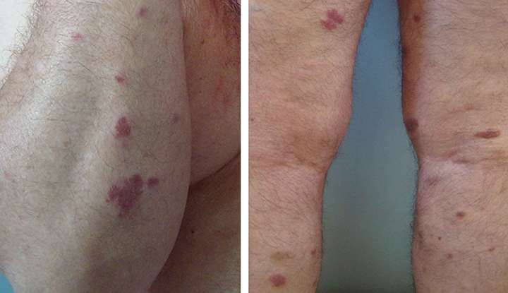 hiv lesions back