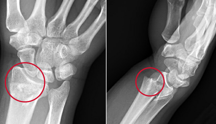 broken hand bones xray