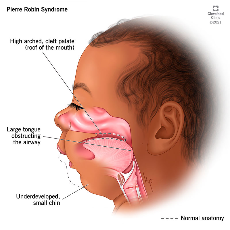 Medical illustration showing the malformation of facial features in Pierre Robin syndrome.