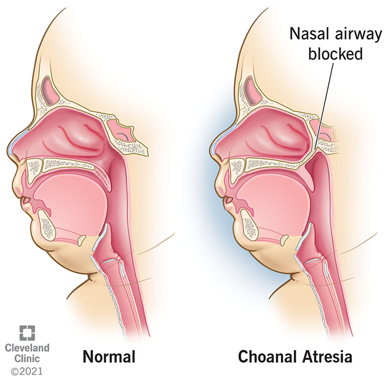 Choanal atresia is categorized by tissue that blocks or narrows the nasal airway.