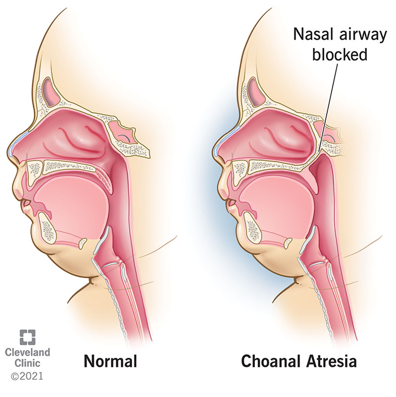 Choanal atresia, with a nasal airway blocked, and a normal airway