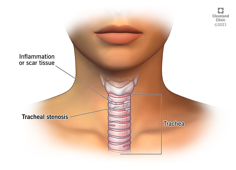 Illustration of Tracheal Stenosis, which is a narrowing of the trachea due to inflammation or scar tissue.