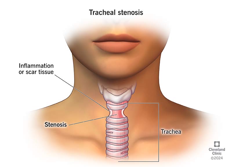 Illustration of Tracheal Stenosis, which is a narrowing of the trachea due to inflammation or scar tissue.