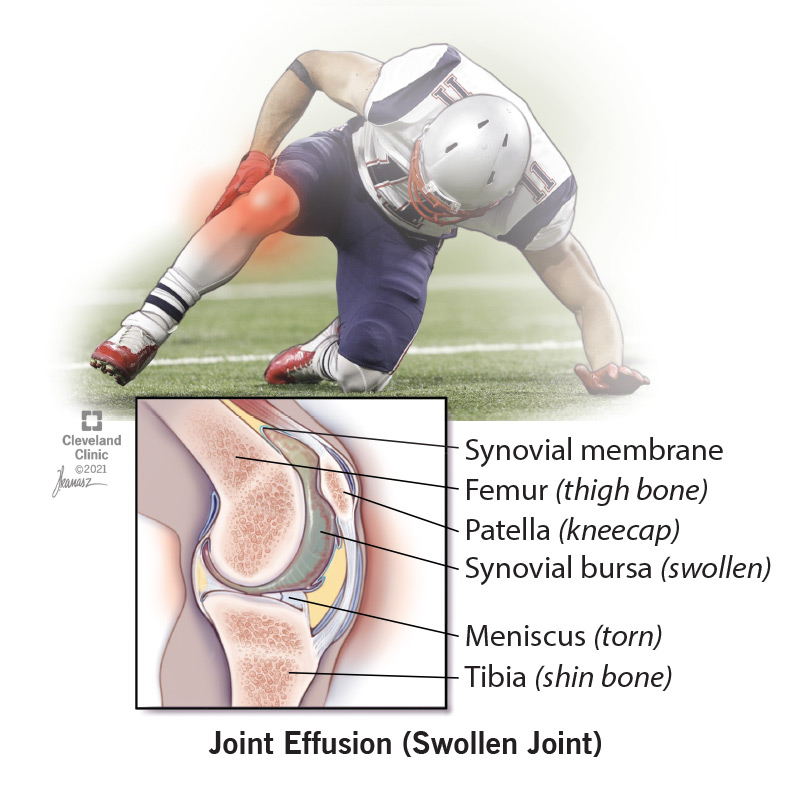 Medical illustration showing a swollen joint affecting an athlete along with an illustration of joint effusion happening on the inside of a knee.