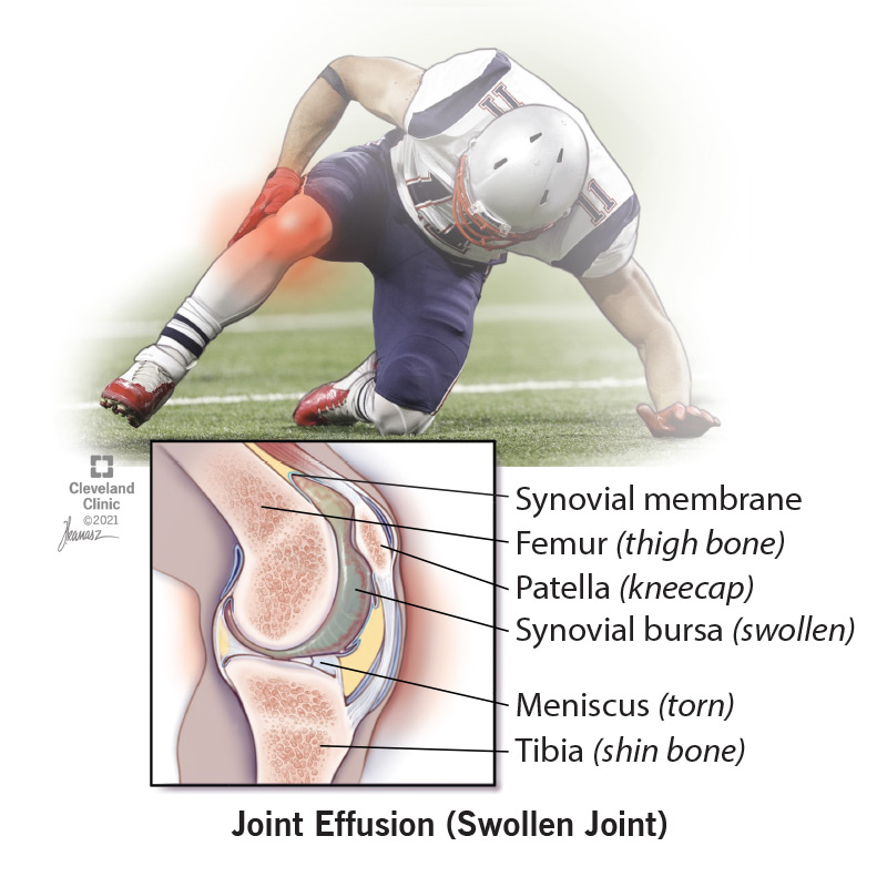 How Long Does A Joint Effusion Take To Heal