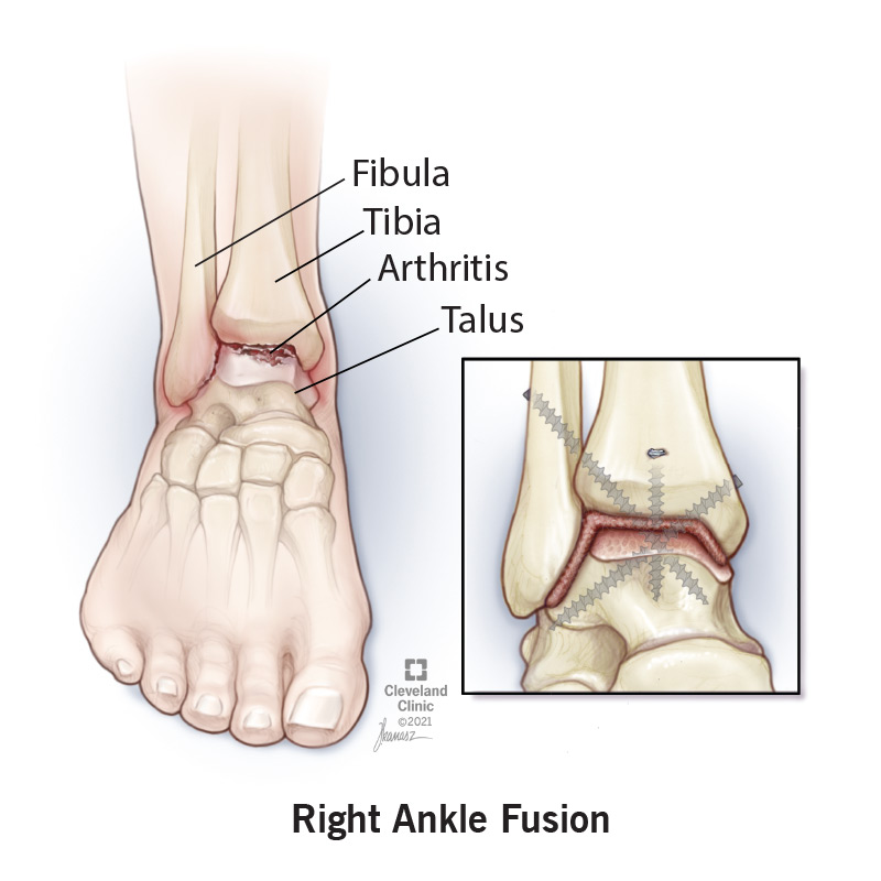 Ankle fusion joins ankle bones (Fibula, Tibia, Talus) together with screws.