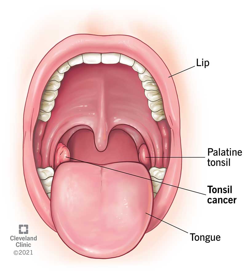 Medical illustration of cancer affecting the tonsils.